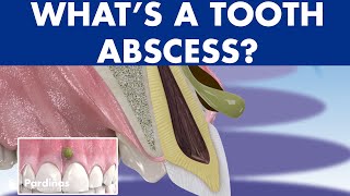 TOOTH ABSCESS dental infection  PHLEGMON symptoms and treatment © [upl. by Assirrec]