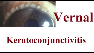 Vernal Keratoconjunctivitis VKC [upl. by Eimas590]