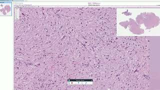 Rosenthal fibers in Pilocytic Astrocytoma  Adventures in Neuropathology [upl. by Schreibe397]