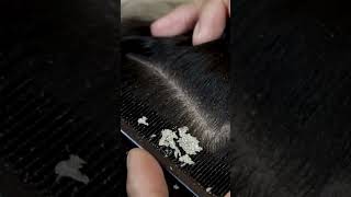 dandruff scratching addiction 101 [upl. by Mota]