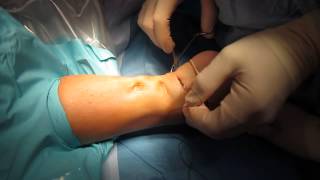 Percutaneous Achilles Tendon Surgery Repair Unedited by Kevin R Stone MD [upl. by Navad]