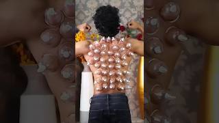 Cupping Therapy Explained Video 😞shorts [upl. by Arednaxela]