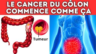 ALERTE  Ce symptôme étrange pourrait indiquer un cancer du côlon [upl. by Nilekcaj532]