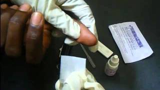 HIV Antibody Test Using a Rapidcard [upl. by Granlund]