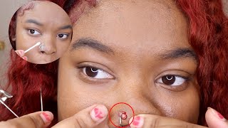 How to pop and Get rid of nose piercing bump keloid FAST [upl. by Jeffy]