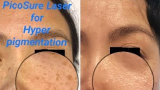 Best laser for pigmentation  picolaser treatment skinrejuvenation draqeel adeelmedics laser [upl. by Ekoorb]