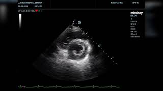 Echocardiographic presentation of loose chordae tendineae versus tertiary chordae rupture [upl. by Ilera88]