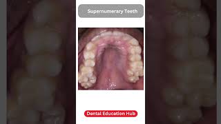 Supernumerary Teeth  Paramolar [upl. by Yadnil939]