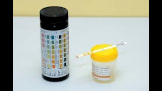 Dipstick Urinalysis Analysis [upl. by Bedelia]