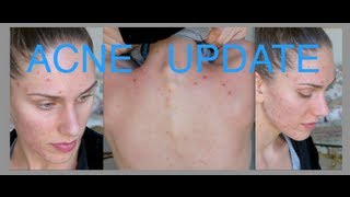 Acne Update For Acne Awareness Month Sunscreen Skincare Routine Summer amp Herbal Supplements [upl. by Eahs456]