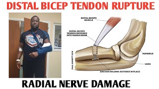 Distal Bicep Tendon Rupture  Radial Nerve Palsy Post Surgery and Diagnosis  Peptides TB500 BPC157 [upl. by Erb25]