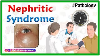 Overview of Nephritic Syndrome  Nephrotic vs Nephritic Syndrome  USMLE Step 1 [upl. by Fiden347]