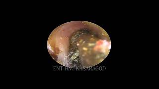 CERUMENV3 Impacted ear wax removed Endoscopic suction clearance [upl. by Nnave704]