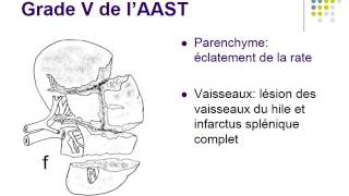 TRAUMATISME SPLENIQUE [upl. by Annawot]