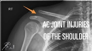 Acromioclavicular AC joint injury Mechanism of injury diagnosis and treatment [upl. by Trix]