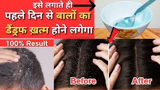 Dandruff Kaise Hataye  Dandruff Treatment At Home  Remove Dandruff From Hair  Permanent Solution [upl. by Lyrehc]