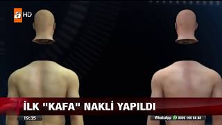 İlk kafa nakli yapıldı [upl. by Rett214]