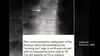 Benign Bone Lesions by Dr Jack Pang [upl. by Inattyrb]