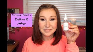 The Ordinary Skincare Argireline  4 MonthFinal Update  Crows Feet [upl. by Tahpos]