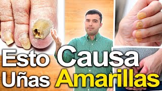 Uñas AMARILLAS Nunca Más  Como Blanquear Uñas Amarillas  Causas y Soluciones Avanzadas [upl. by Ilrahc298]