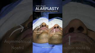 Asymmetrical Nose Correction  Alarplasty by Dr Adarsh Tripathi [upl. by Euqinor]