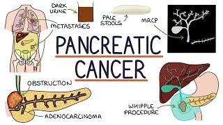 Understanding Pancreatic Cancer [upl. by Analak]