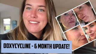 DOXYCYCLINE  6 month update ACNE JOURNEY [upl. by Bard]