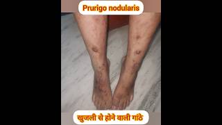 PRURIGO NODULARIS शरीर पर गांठे खुजली से itching nodules skincare shortsfeed shorts ytshorts [upl. by Pennie]