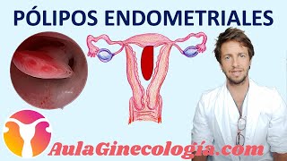 PÓLIPOS UTERINOS Causas riesgo de cáncer diagnóstico y tratamiento  Ginecología y Obstetricia [upl. by Munshi]