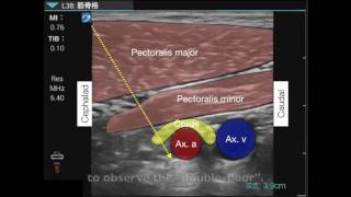 Brachial plexus infraclavicular approach [upl. by Randolf]