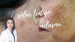 Whats the difference Solar Lentigo vs Melasma [upl. by Reckford]