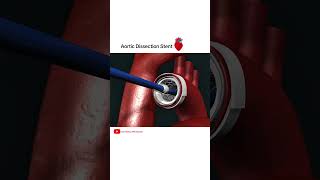 Aortic dissection Stent grafting cardiology shorts [upl. by Notyarb]