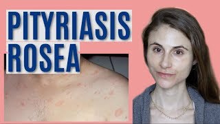 PITYRIASIS ROSEA WHAT IT IS amp GETTING RID OF IT DR DRAY [upl. by Zevahc]