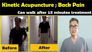 Acupuncture treatment for acute low back pain  Kinetic Acupuncture Back Pain Treatment [upl. by Aicelaf]