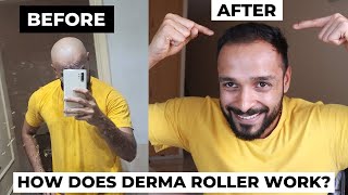 Derma Roller hair regrowth before and after  Does Microneedling actually work in reducing DHT [upl. by Cirle464]