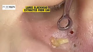 LARGE BLACKHEAD EXTRACTED FROM EAR  PURESKIN Beauty Spa Reacts Dr Dona Cravos asmr [upl. by Ecirtap]