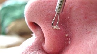 3B of 4 Removing Blackheads amp Whiteheads Using A Comedone Extractor Tool HD [upl. by Etteve]