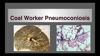 Pneumoconiosis Coal workers pneumoconiosis [upl. by Atiuqram917]