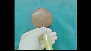 Septic Infected Total Knee Replacement Arthroplasty Joint Aspiration [upl. by Anyat698]