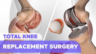 Total Knee Replacement Surgery Knee Arthroplasty [upl. by Kahn935]