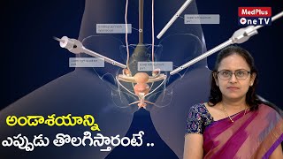 Oophorectomy Causes  DrHimabindu Annamraju MedPlusONETV [upl. by Einaffets956]