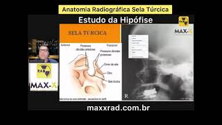 Anatomia Radiográfica da Sela Túrcica Estudo da Hipófise [upl. by Lyon]