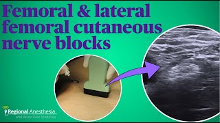 Femoral and lateral femoral cutaneous nerve blocks [upl. by Eldoree80]