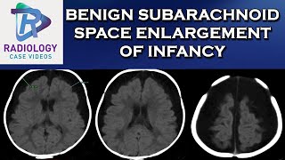 Benign Subarachnoid Space enlargement of infancy [upl. by Flannery300]