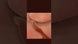 what is angioplasty 🫀Angioplasty Procedure Animation video [upl. by Mar]