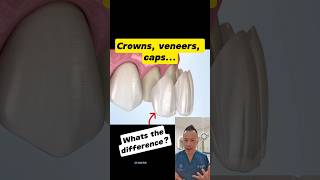 Crowns Veneers or Caps Whats the Difference dentallan dentist shorts [upl. by Arline53]