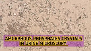 Amorphous Phosphates crystals seen in urine microscopyAlkaline crystalsRoutine urine examination [upl. by Lea389]