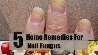 5 Home Remedies For Nail Fungus [upl. by Mali]