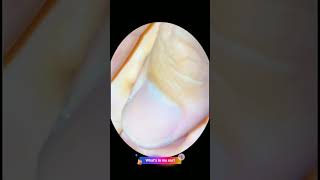 Earwax Removal Part 49 [upl. by Freberg]