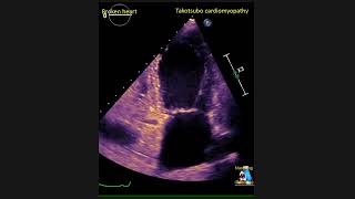 Takotsubo Cardiomyopathy  Broken Heart shorts [upl. by Afatsom]